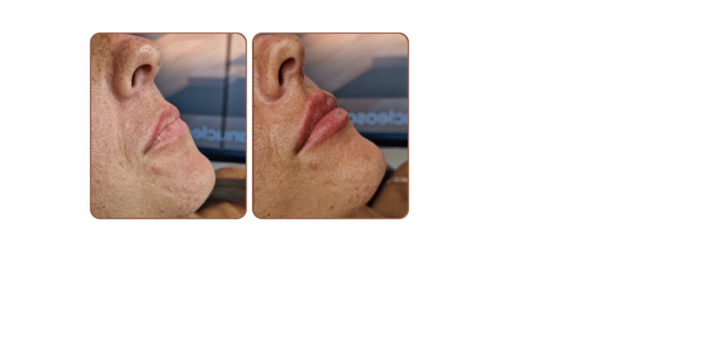 Antes y después aumento de labios