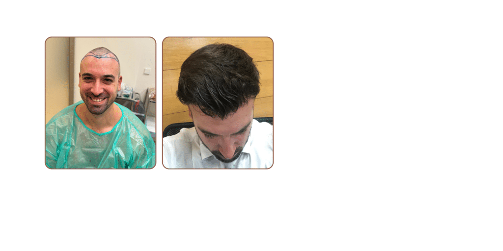 antes y después injerto capilar