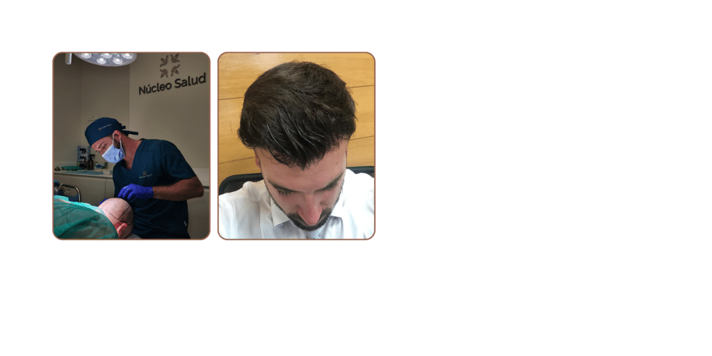 antes y después de un injerto capilar